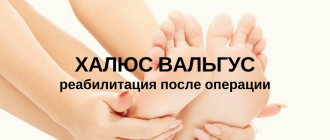 Реабилитация после операции Халюс Вальгус