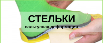 стельки при вальгусной деформации