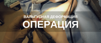 Операция при вальгусной деформации